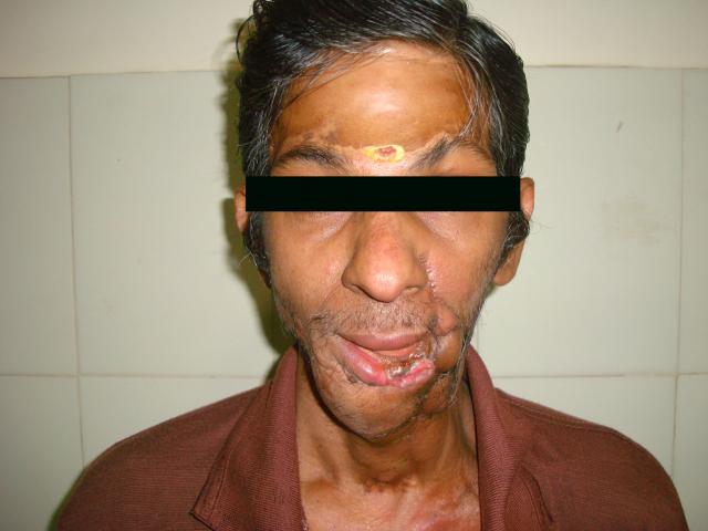 2nd Post op picture